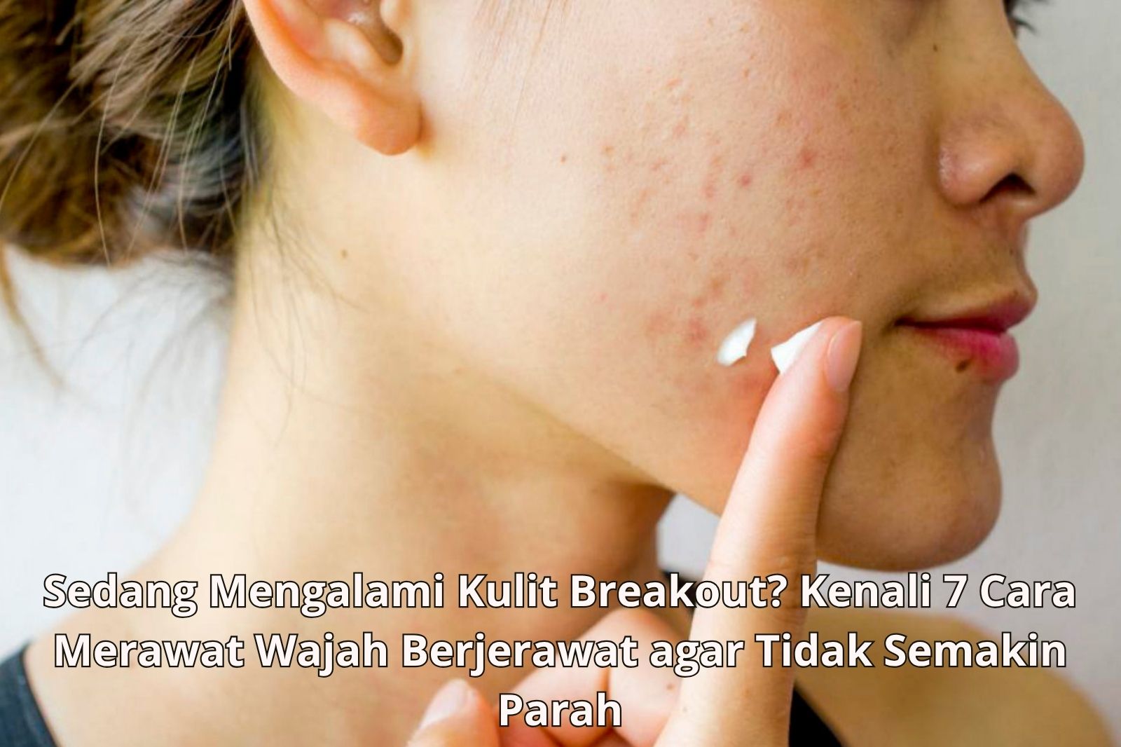 Sedang Mengalami Kulit Breakout? Kenali 7 Cara Merawat Wajah Berjerawat ...